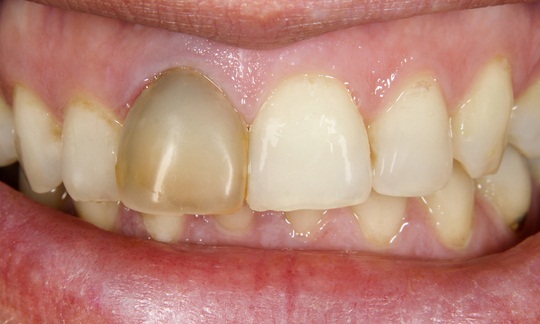 Przyczyny przebarwiania zębów